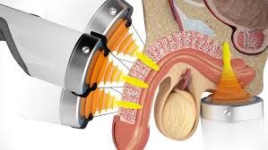 Emsella for Erectile Dysfunction