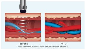 Shockwave Therapy